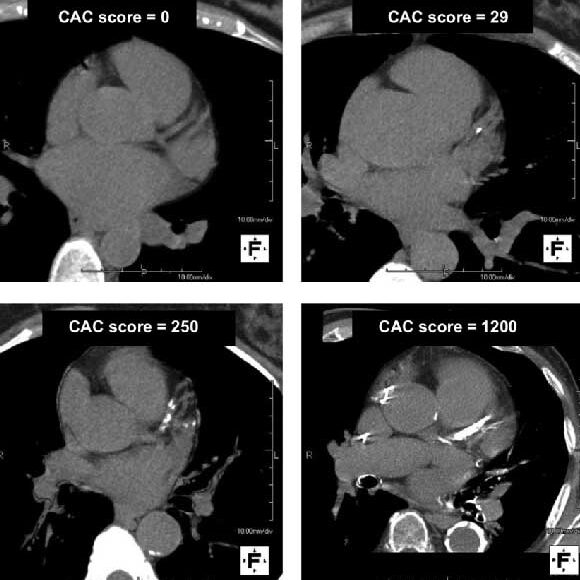 https://ctcorelab.com/wp-content/uploads/2024/10/calcium-CT-scans-e1731291746654.jpg
