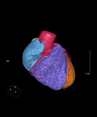 https://ctcorelab.com/wp-content/uploads/2025/03/Low-Res_CTA-Coronary-artery-3D-rendering-image-for-detect-coronary-artery-disease.jpeg